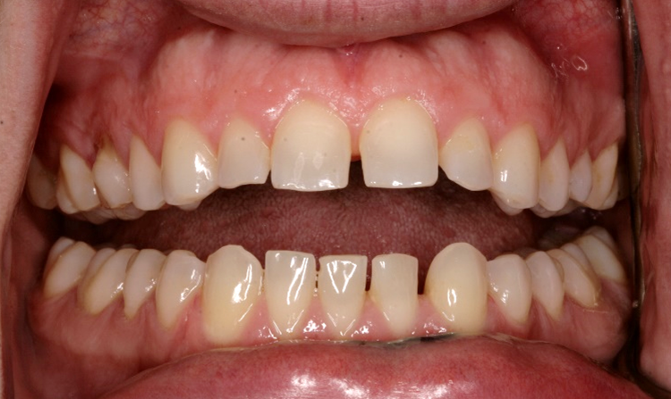 Before Invisalign Treatment And Porcelain Veneers — Edina, MN — Interlachen Dental Associates	