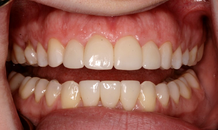 After Invisalign Treatment And Porcelain Veneers — Edina, MN — Interlachen Dental Associates	
