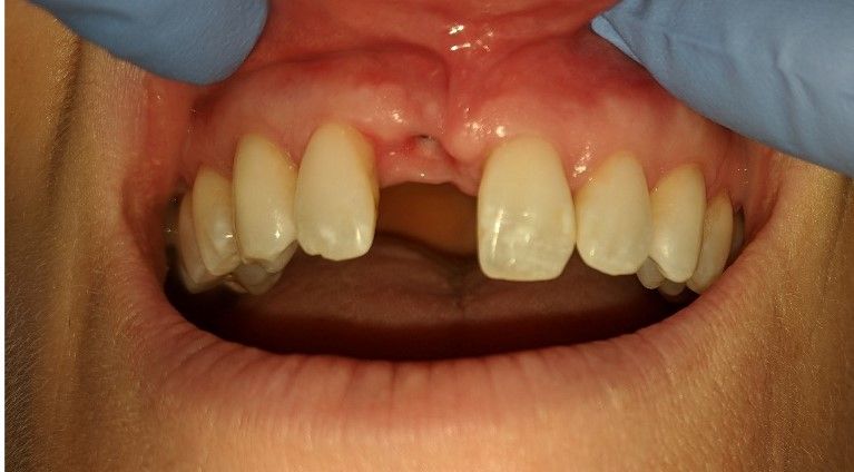 Before Dental Implant Crown — Edina, MN — Interlachen Dental Associates	