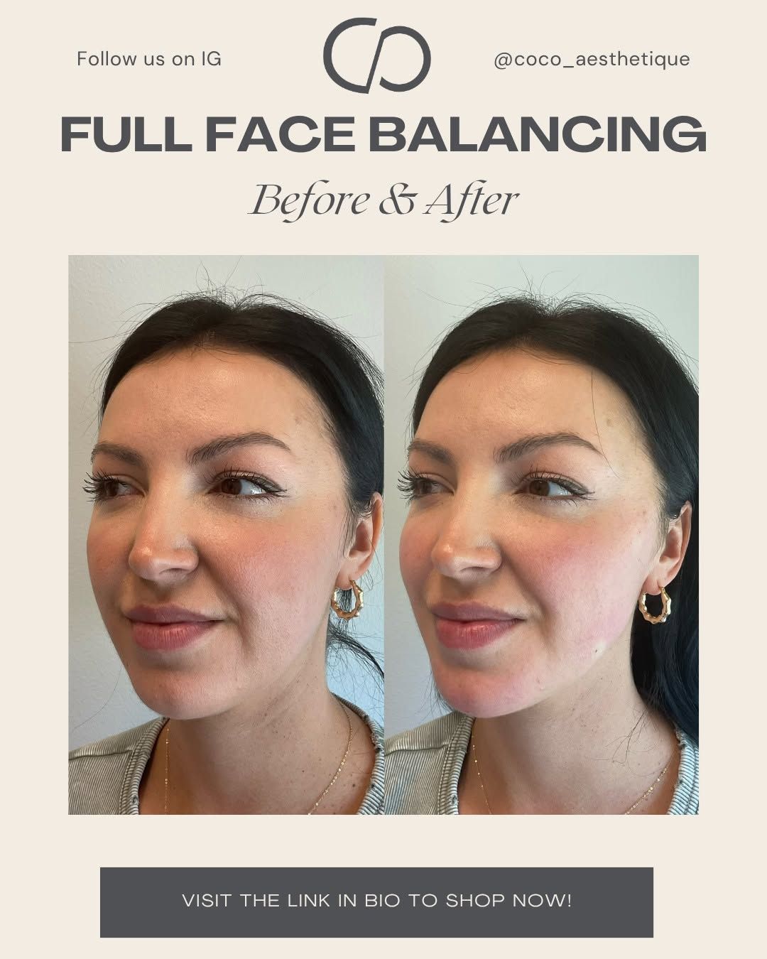 Before and after photos of a woman’s face, showcasing the results of full face balancing. She is smiling, with visible improvements.
