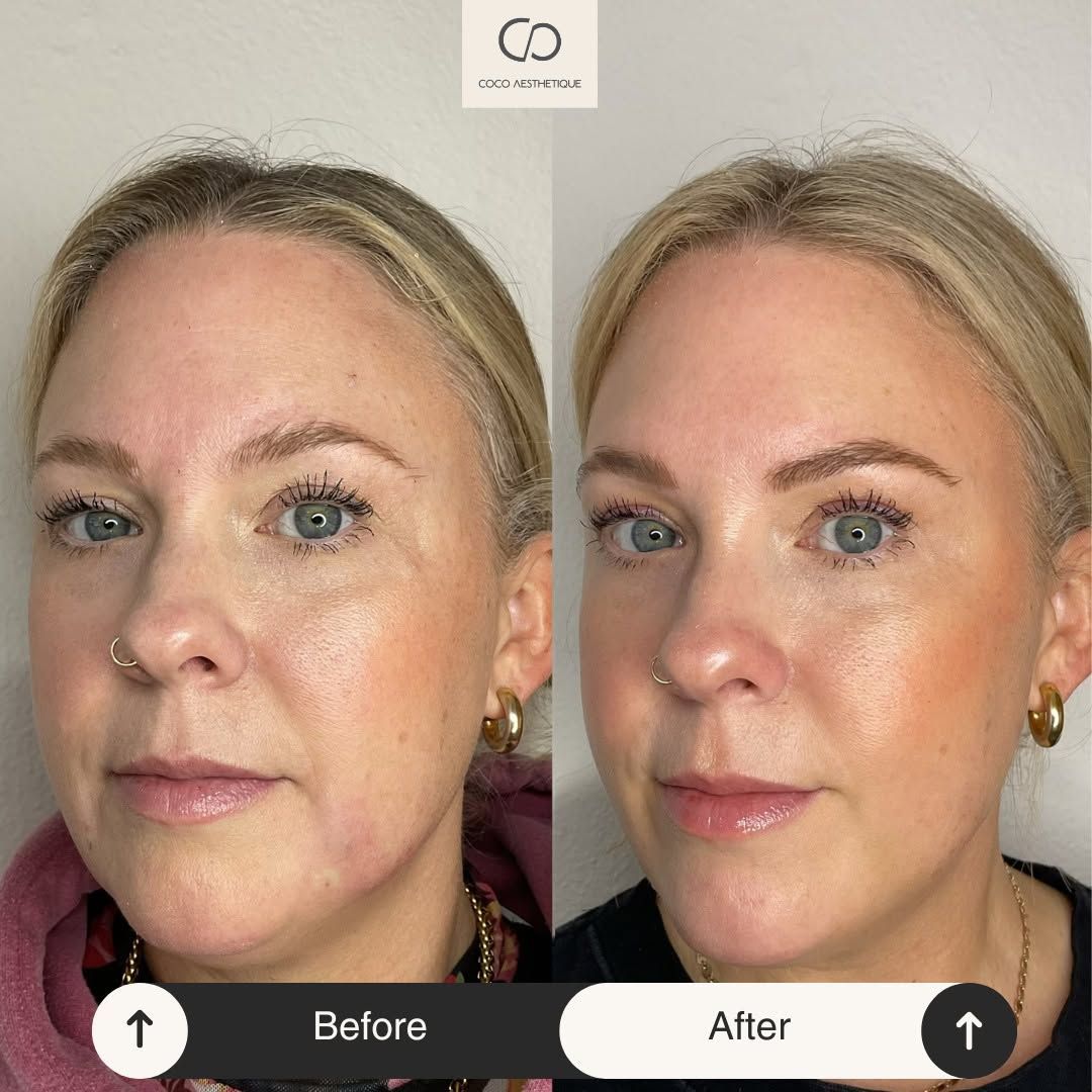 Before-and-after comparison of a woman's face. The