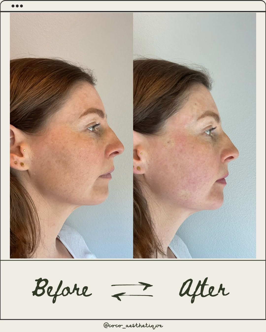 Comparison of a woman's side profile before and after a cosmetic procedure, showing a more defined jawline.