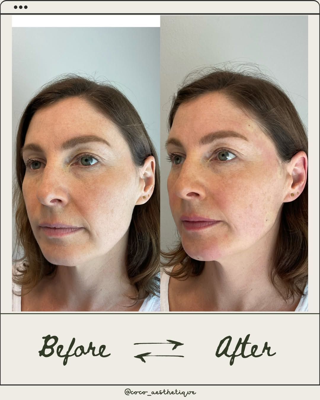 Side-by-side photos show a woman's face before and after a procedure. The