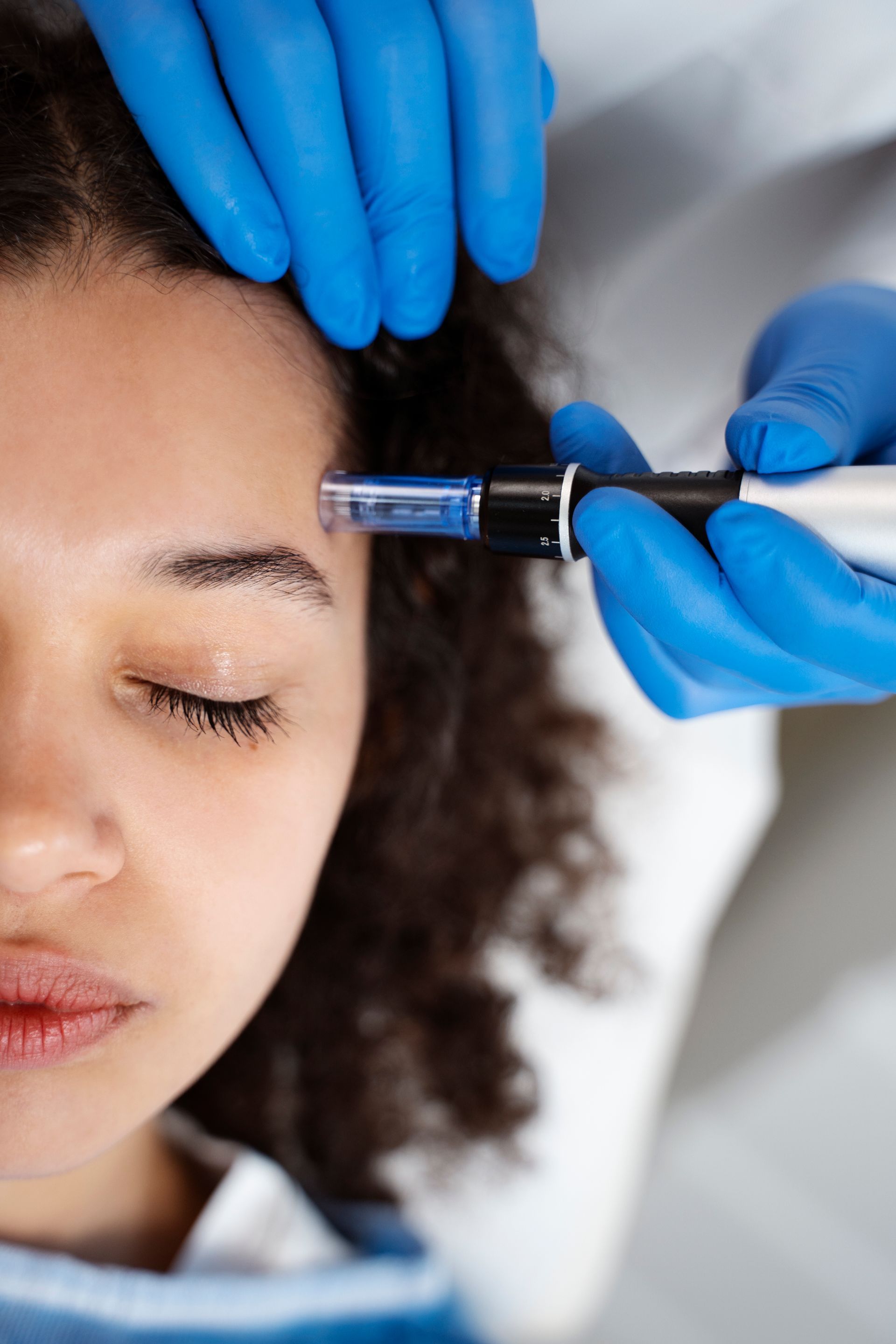 A person receiving a facial micro-needling treatment. A technician in blue gloves uses a pen-like device on the person's forehead.