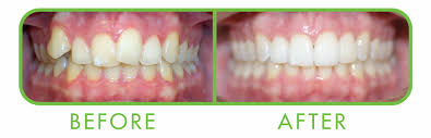 Clear Correct Before and After — Yorktown, VA — Scott J. Golrich, DMD