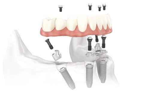 Tooth Implant Illustration — Yorktown, VA — Scott J. Golrich, DMD