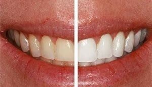 Teeth Whitening — Yorktown, VA — Scott J. Golrich, DMD