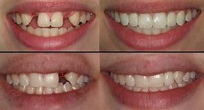 Bridgework Before and After — Yorktown, VA — Scott J. Golrich, DMD