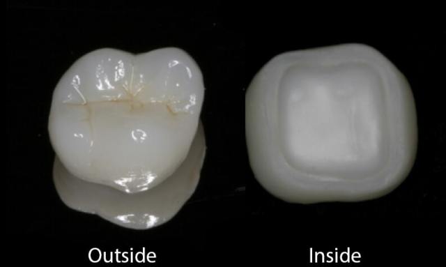 Tooth with Inside and Outside Crown — Yorktown, VA — Scott J. Golrich, DMD