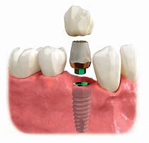 Tooth Implant — Yorktown, VA — Scott J. Golrich, DMD
