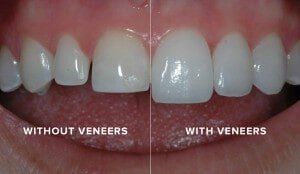 Teeth without Veneers and with Veneers — Yorktown, VA — Scott J. Golrich, DMD