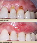 Pinhole Gum Rejuvenation Before and After — Yorktown, VA — Scott J. Golrich, DMD
