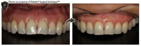 Pinhole Gum Rejuvenation — Yorktown, VA — Scott J. Golrich, DMD