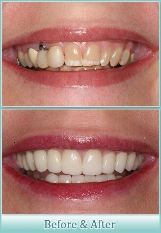 Tooth with Crown Comparison — Yorktown, VA — Scott J. Golrich, DMD