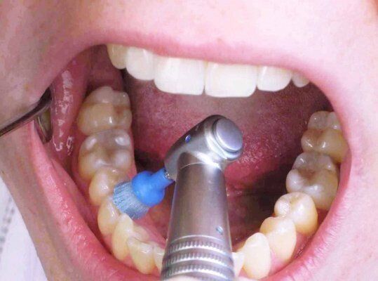 Teeth Cleaning — Yorktown, VA — Scott J. Golrich, DMD