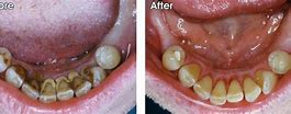 Before and After Teeth Cleaning — Yorktown, VA — Scott J. Golrich, DMD