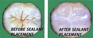 Before and After Sealant Placement — Yorktown, VA — Scott J. Golrich, DMD