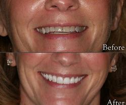 Teeth Before and After Veneers Comparison — Yorktown, VA — Scott J. Golrich, DMD