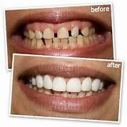 Teeth Before and After Veneers — Yorktown, VA — Scott J. Golrich, DMD