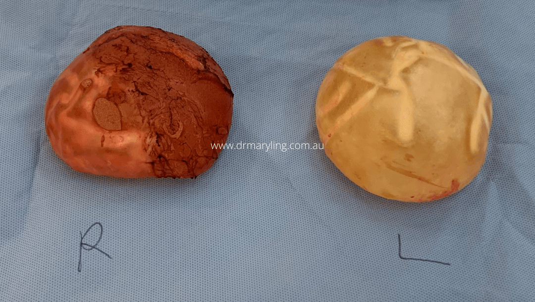 Breast Implant Removal Central Coast & Newcastle | Explant Surgery