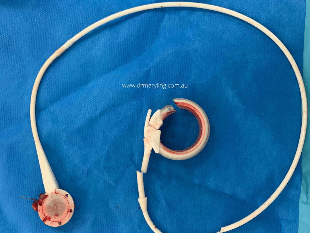 Gastric band removal