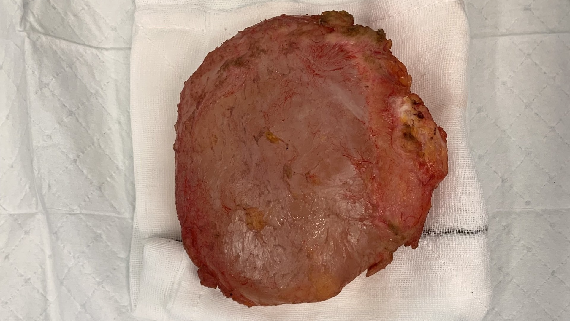 Total Intact Capsulectomy PIP Implant
