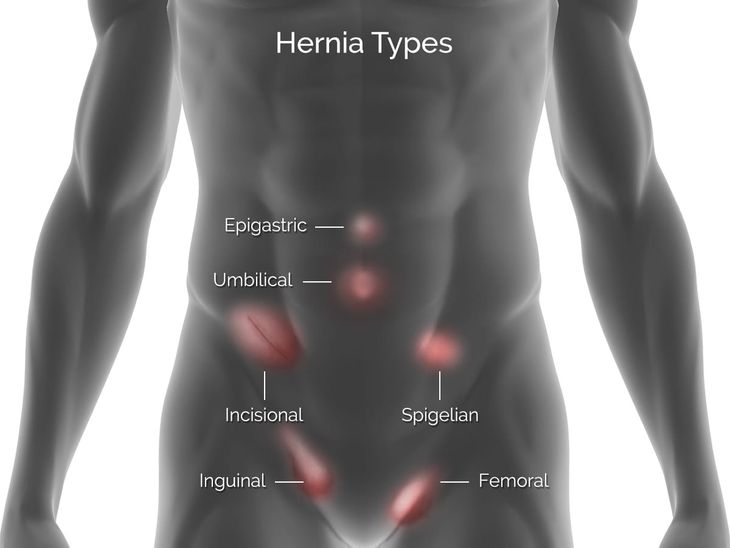 Hernia Hernia Surgery Central Coast