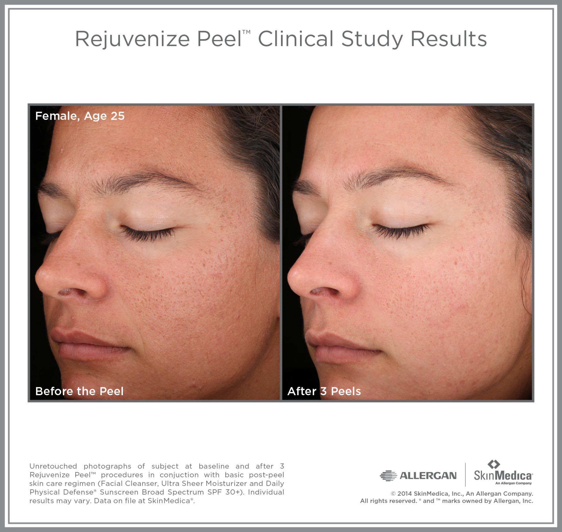 SkinMedica Peel Results on 25 yr old female. Before and After photo on 3 treatments.