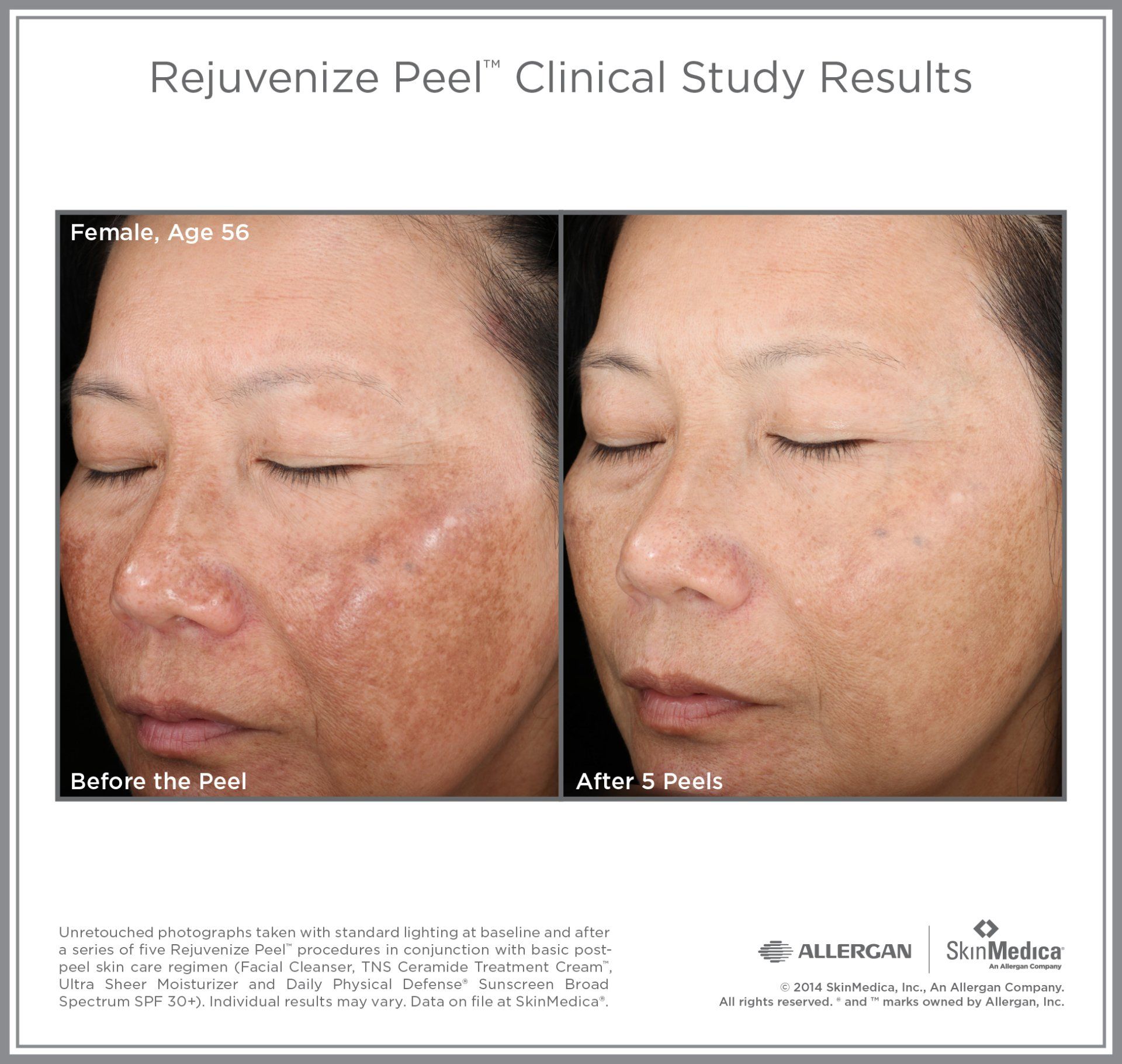 SkinMedica Peel Results on 56 yr old female. Before and After photo on 3 treatments.