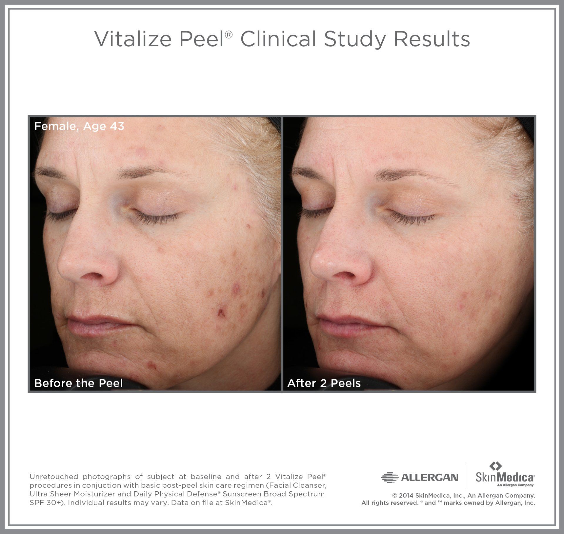 SkinMedica Peel Results on 43 yr old female. Before and After photo.