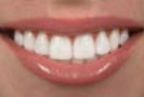 Veneers — Dentals Services in Orland Park, Illinois