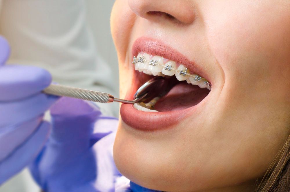 4 Affordable Braces Payment Plan Options To Consider