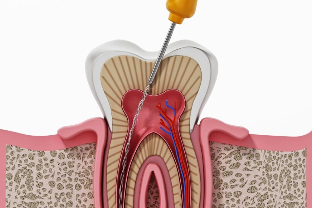 Are Dental Veneers Worth It? Pros And Cons Explained