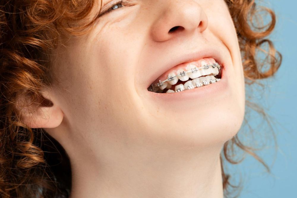6 Benefits Of Braces Beyond A Straighter Smile
