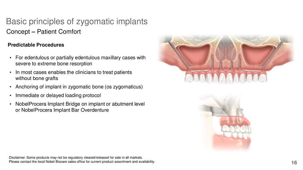 Zygomantic implants