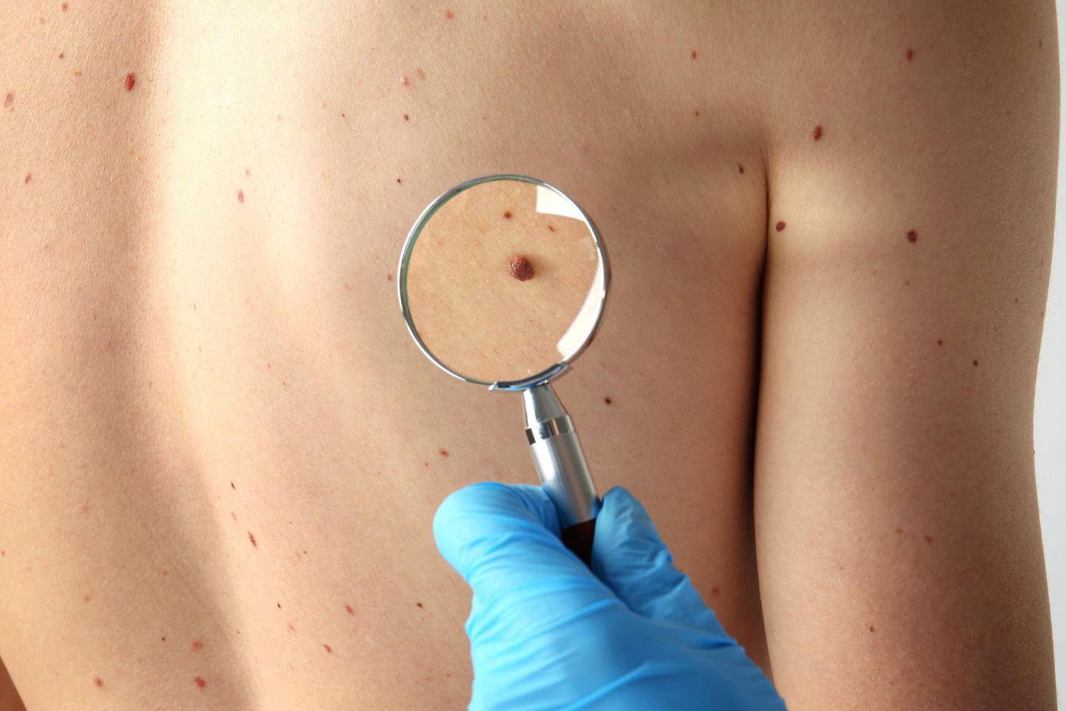 Doctor examining a mole on a patient's back with a magnifying glass. The doctor wears blue gloves.
