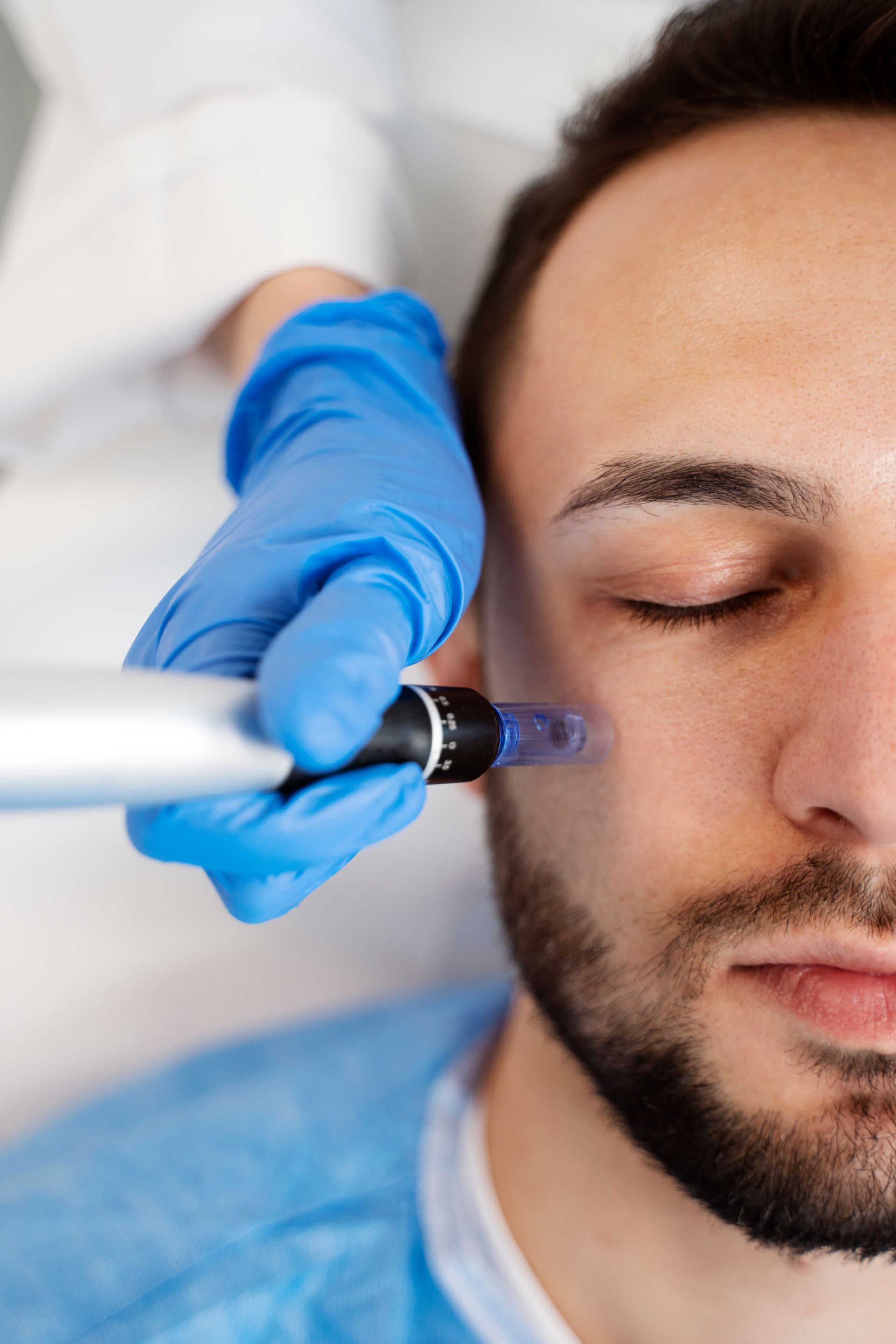 A person receiving a microneedling treatment on the face. Blue-gloved hand holds device.