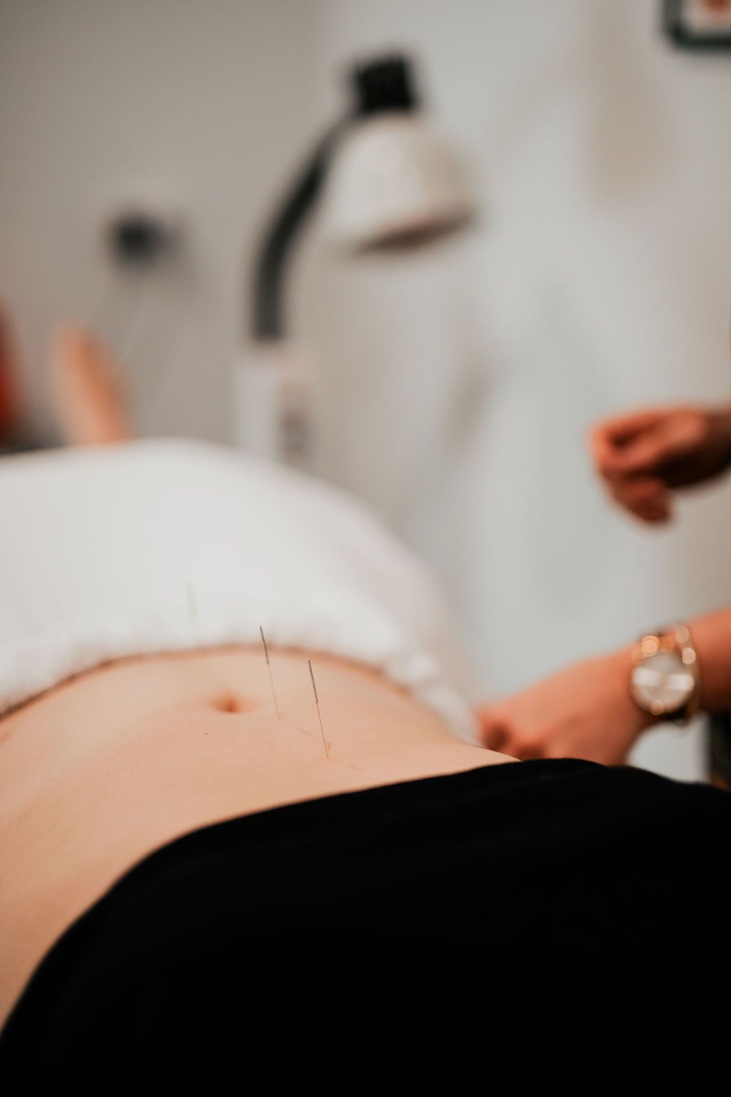 A woman is getting acupuncture on her stomach for menstrual health.