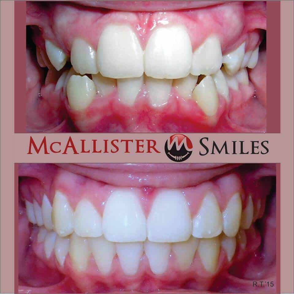 A before and after picture of a person 's teeth from McAllister smiles.