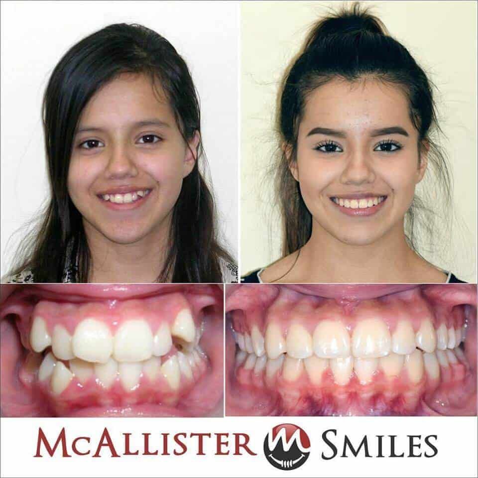 A before and after photo of a girl 's teeth by McAllister smiles.
