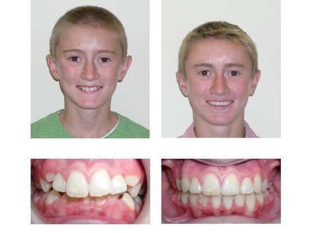 A before and after picture of a young boy's teeth.