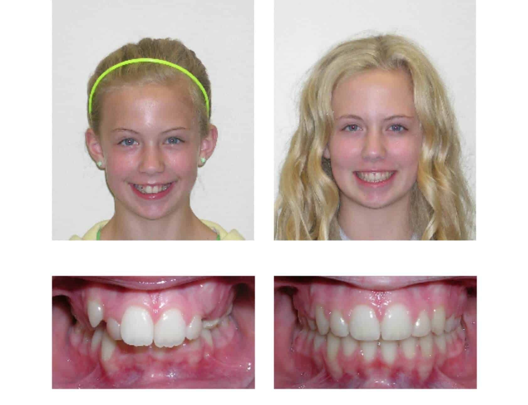 A before and after picture of a young girl's teeth.