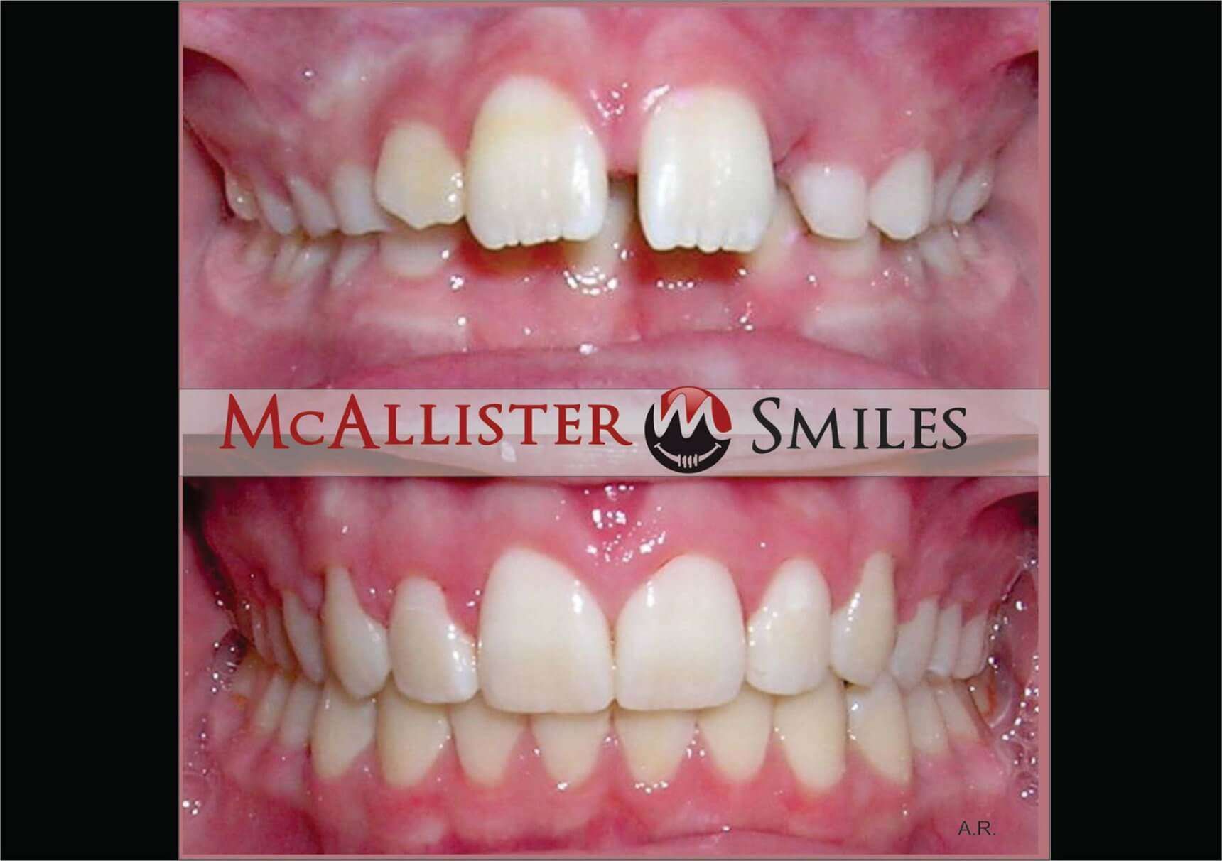 A before and after picture of a person 's teeth from McAllister smiles.