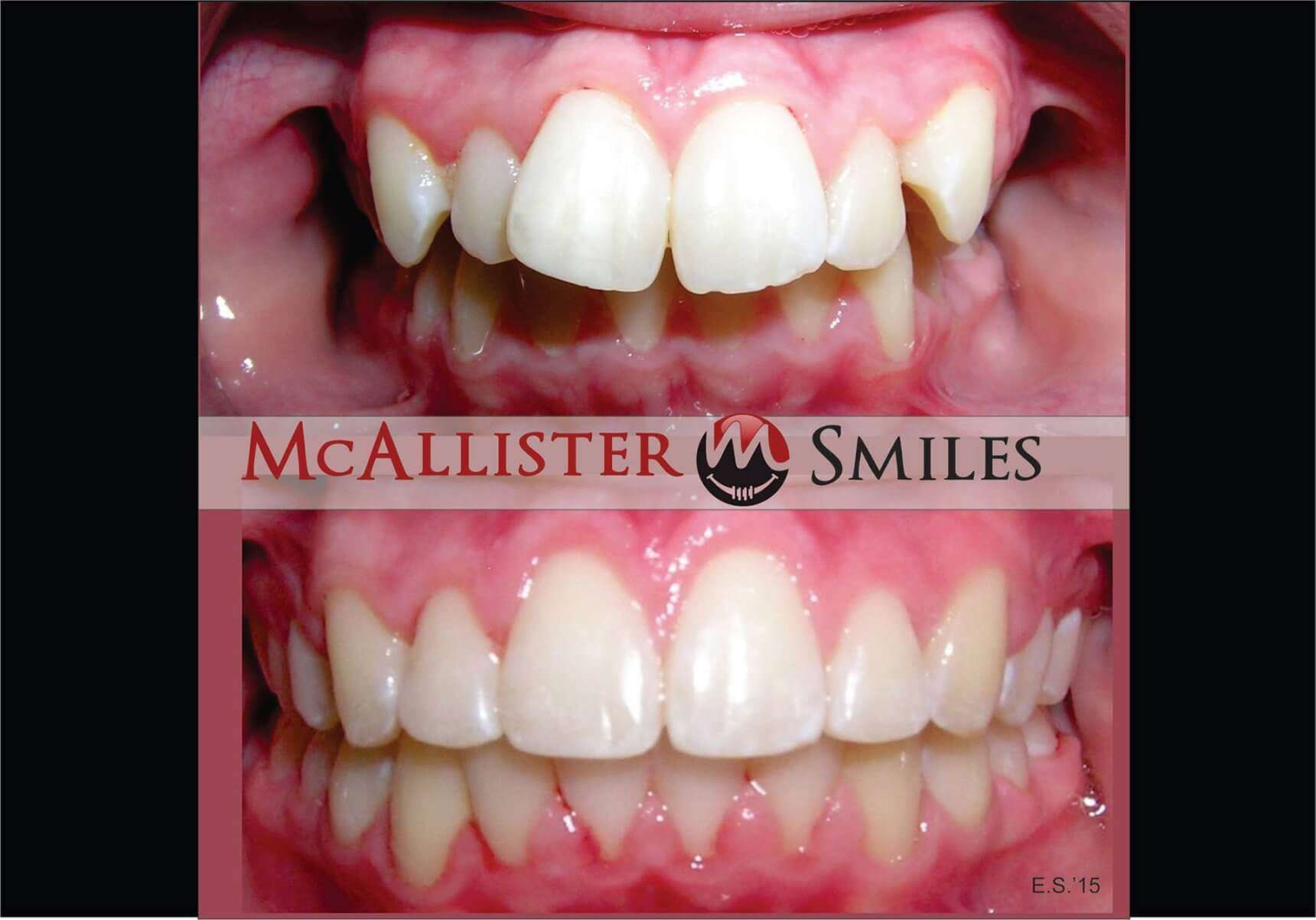 A before and after picture of a person 's teeth from McAllister smiles.