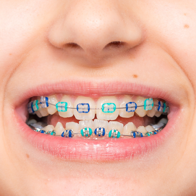 5 Types of Braces for Teeth – Metal, Ceramic, Self Ligating, Lingual and  Aligners