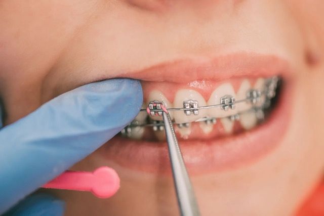 putting braces on