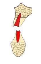 Classe II post estrattiva