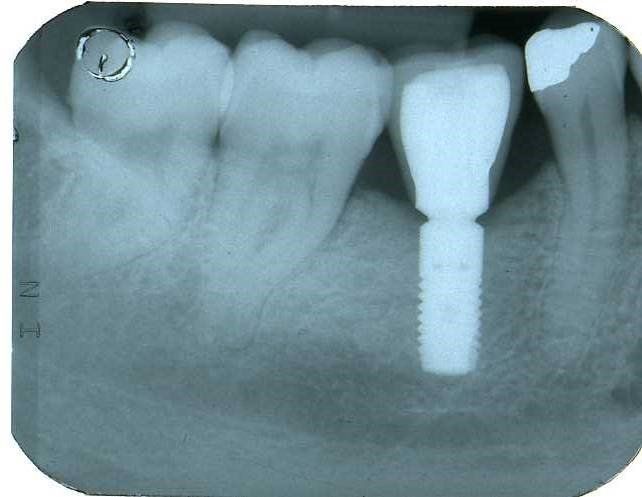 rimozione della radice