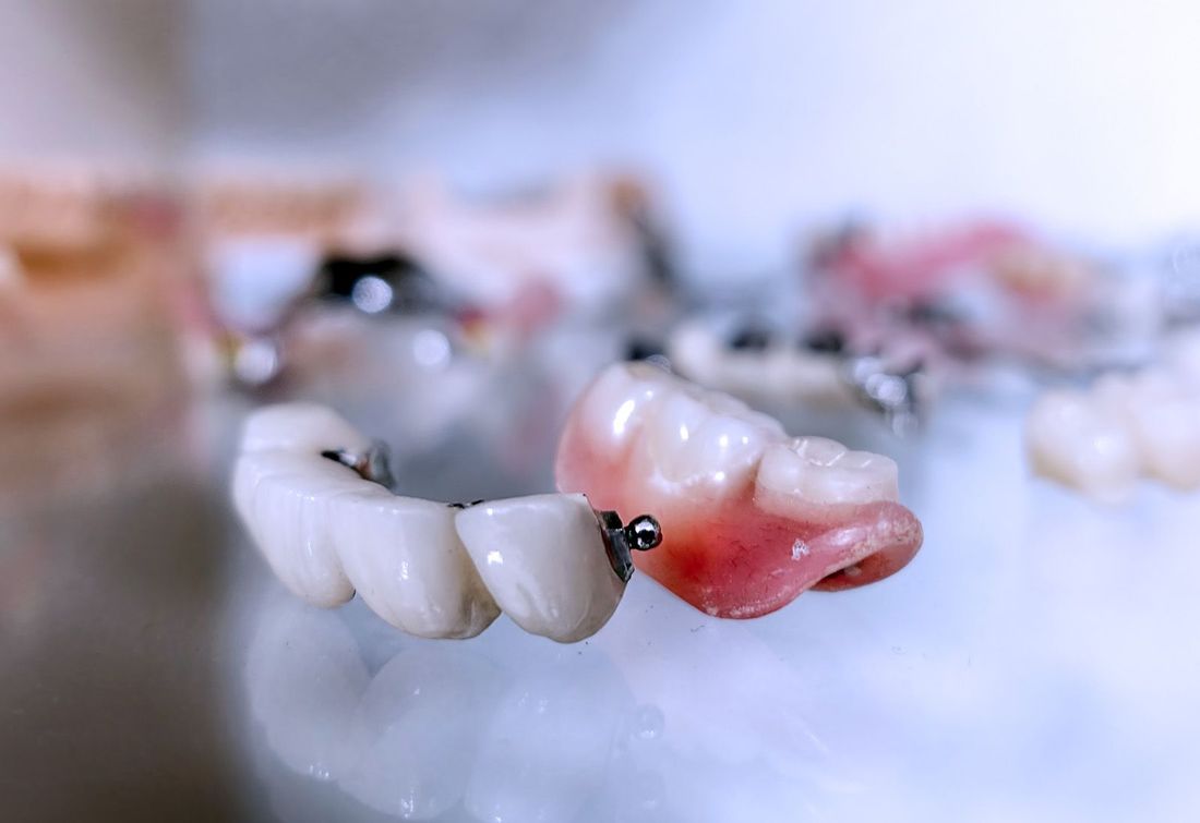 protesi fissa su denti naturali