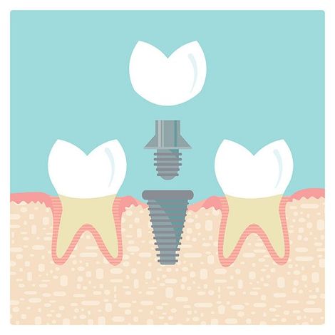 Dental — Dental Implant Illustration in Mansfield, OH